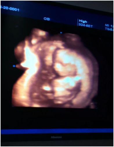 3-D ultrasound