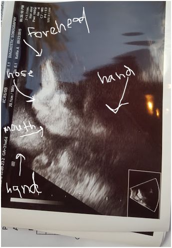 ultrasound pic